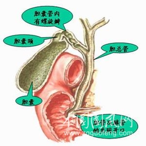 多发性胆囊息肉的原因及病发症状